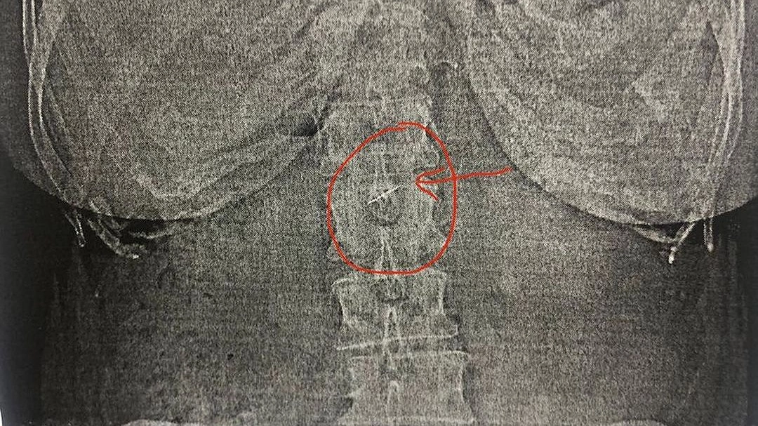 На приеме у стоматолога жительница Новороссийска проглотила острый инструмент