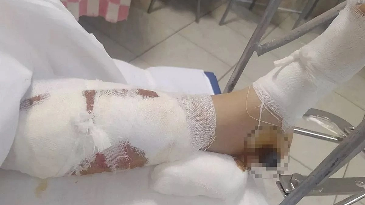 Перелом назвали царапиной: почему после наезда на девочку в Краснодаре не завели уголовное дело