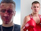 В Феодосии чемпион по боксу попал в больницу после драки