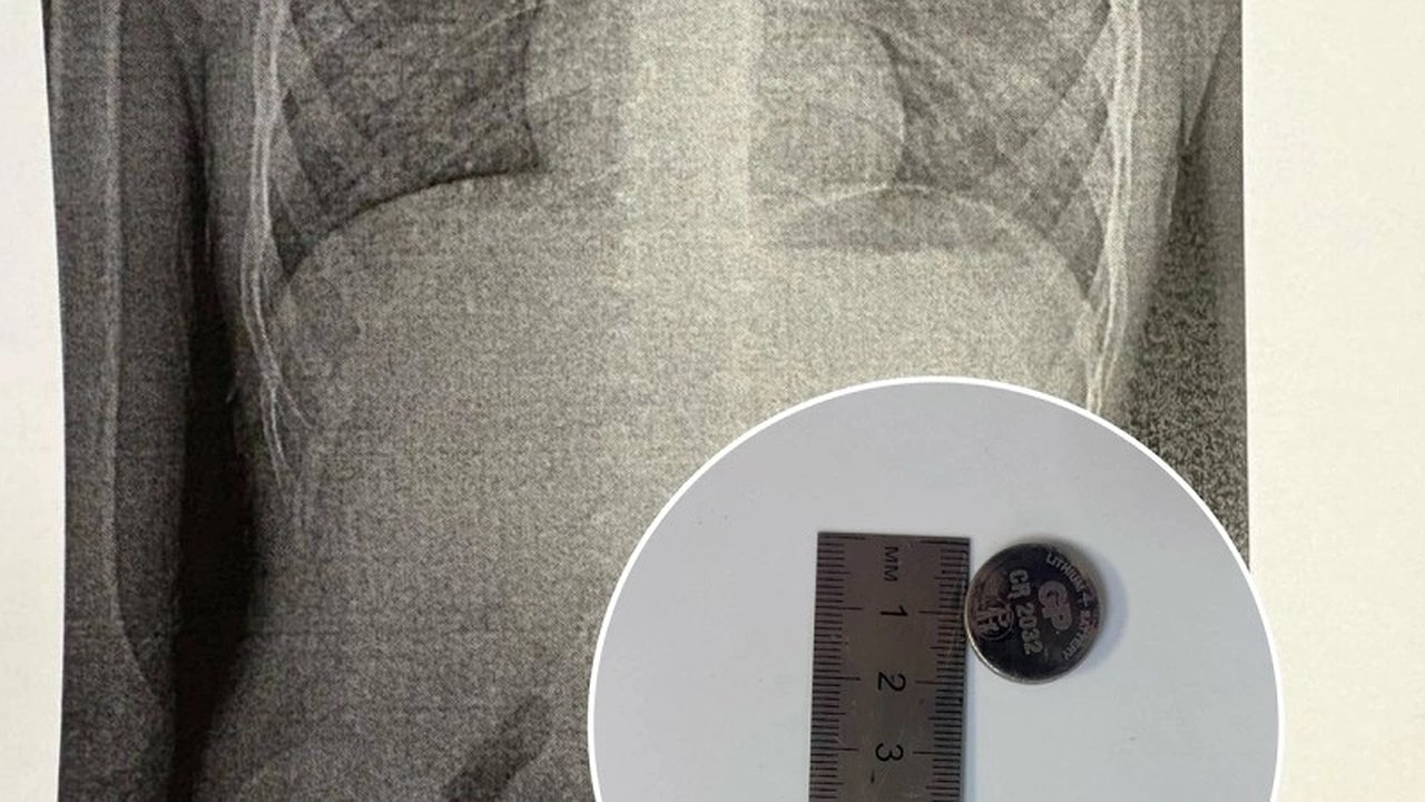 Главная картинка новости: Успешно проведена операция по извлечению батарейки из желудка 7-летнего ребенка